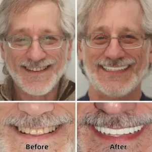 –Advanced Custom-Fit Functional Dentures - Image 5