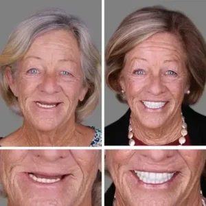 Premium Dentures - Image 3