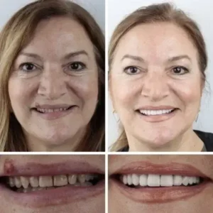 Premium Dentures