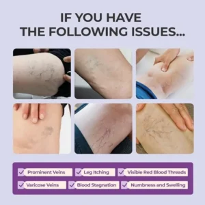 Leg Relief Varicose Veins Cream - Image 3