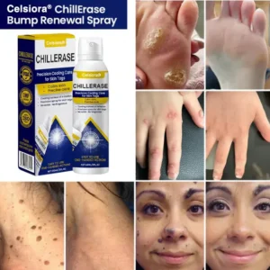 ChillErase Cooling Spray for Skin Tags - Image 2