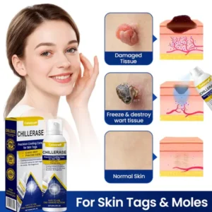 ChillErase Cooling Spray for Skin Tags - Image 4