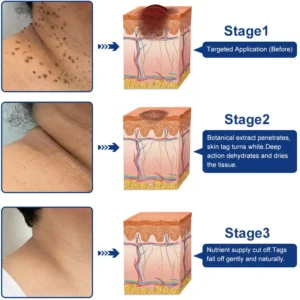 Targeted Skin Tag & Wart Removal Cream – Time-Released Phyto-Exfoliant (12% Celandine ) & Bio-Active Terpene Viral-Inhibitor (8% Thuja) - Image 6