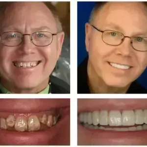 🦷 Custom-Fit Functional Dentures 😁 Smile with Confidence - Image 3