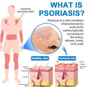 Magnesium Herbal Psoriasis Spray - Image 10