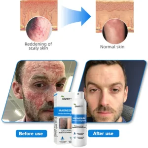 Magnesium Herbal Psoriasis Spray - Image 3