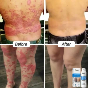 Magnesium Herbal Psoriasis Spray - Image 8