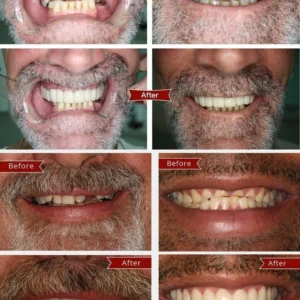 FLASH SALE: Fix Your Smile in 30 Seconds — 👨‍⚕Adjustable SnapOn Dentures😁 - Image 3