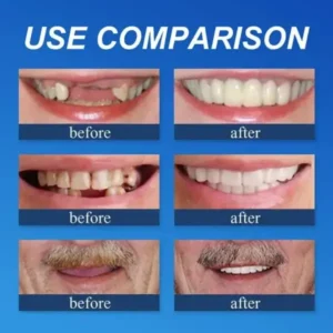 Full Denture with Strong Suctiond Custom-Fit Full Functional Dentures🦷 - Image 6