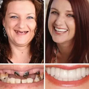 Full Denture with Strong Suctiond Custom-Fit Full Functional Dentures🦷 - Image 8