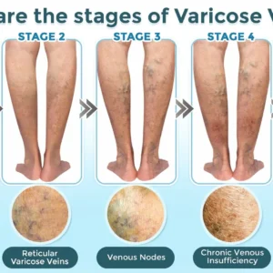 VenaRestore MicroNeedle Vein Repair Patch - Image 5