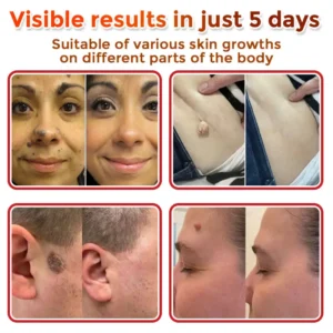MicroNeedle Botanic Skin Tag Removal Patch - Image 12