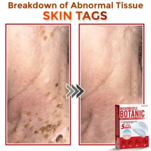 MicroNeedle Botanic Skin Tag Removal Patch - Image 2