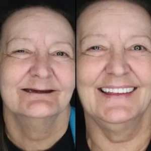 Custom-Fit Functional Dentures — Combination pack - Image 2