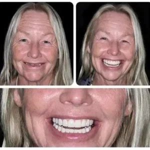 Custom-Fit Functional Dentures — Combination pack - Image 3