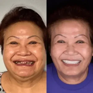 SmileFitPro BioFusion Dentures - Image 8