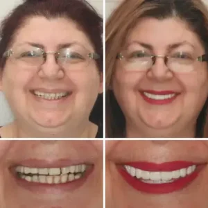 -🦷Advanced Customized Full Denture Set🦷 (⏰Limited time discount last 30 minutes⏰) - Image 7