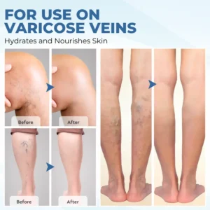 TheraVein Varicose Herbal Spray - Image 6