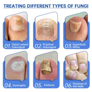 PureNail Fungus Laser Device - Image 11