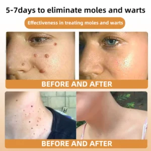Bee Venom Wart & Tag Removal Cream - Image 8