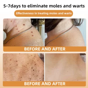 Bee Venom Wart & Tag Removal Cream - Image 4