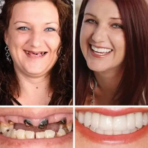 2026 Full Denture | Secure Suction Fit - Image 12