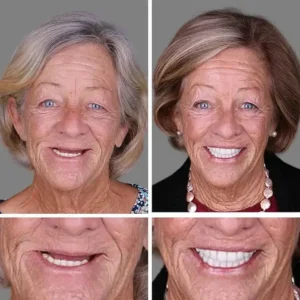 2026 Full Denture | Secure Suction Fit - Image 9