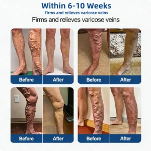 Vein Relief Patch｜Smoother-Looking Legs - Image 6