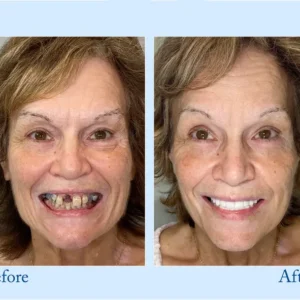 Custom-Fit Functional Dentures — Perfectly Fitted in Minutes at Home - Image 11