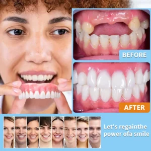 Easy Denture Set, Comfortable Smile Makeover - Made and Shipped from the USA🍀 - Image 2