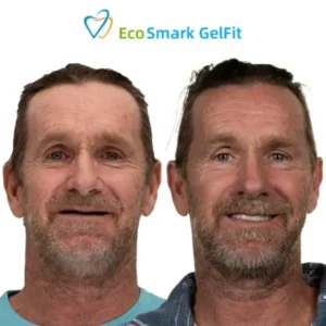 EcoSmark GelFit Dentures - Image 7