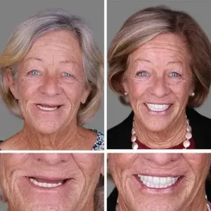 🏆Ends Today: 70% OFF! 🏆2026 Bestselling Product🦷 Fit for a Fresh Smile, Say Goodbye to Wearing Discomfort!🌎 - Image 10