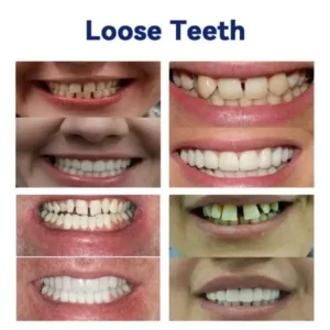 Ease Dentures - Image 5
