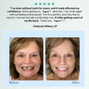 🦷Advanced Customized Full Denture Set🦷 (🔥10,000+ Sold In Last 30 Day) - Image 12