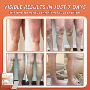 Vein Ease Microneedle Care Patch - Image 6