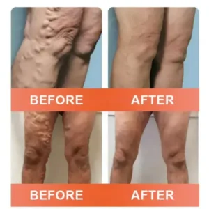 Vein Ease Microneedle Care Patch - Image 7