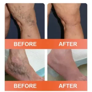 Vein Ease Microneedle Care Patch - Image 8