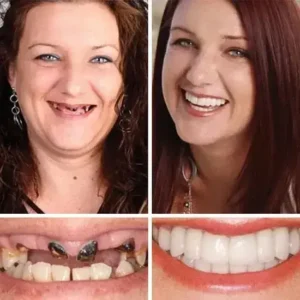 ⏰Ends Today: 70% OFF! Custom-Fit Dentures— Designed for Comfort and a Natural-Looking Smile - Image 11