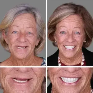 ⏰Ends Today: 70% OFF! Custom-Fit Dentures— Designed for Comfort and a Natural-Looking Smile - Image 10
