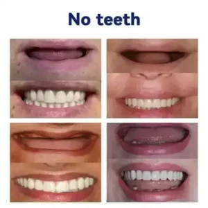 -🦷𝐀𝐝𝐯𝐚𝐧𝐜𝐞𝐝 𝐂𝐮𝐬𝐭𝐨𝐦𝐢𝐳𝐞𝐝 𝐅𝐮𝐥𝐥 𝐃𝐞𝐧𝐭𝐮𝐫𝐞 𝐒𝐞𝐭🦷 (🌟Limited time discount last 30 minutes🌟)🌟🌟 - Image 7