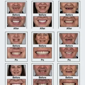 Premium Denture 2026 | Secure Custom Fit - Image 4