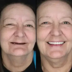 -Custom-Fit Functional Dentures - Image 2