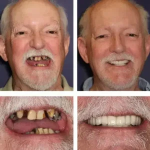 -Custom-Fit Functional Dentures - Image 5
