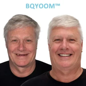 GelFit Dentures - Image 2