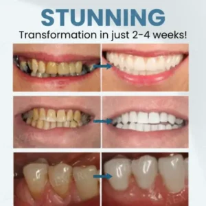 Bee Venom Teeth Restoration Powder - Image 2