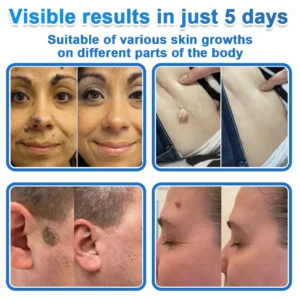 2-in-1 Microneedle + Hydrocolloid Skin Patch Repair System - Image 2
