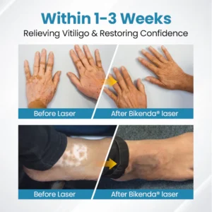 Vitiligo Therapy Device - Image 11