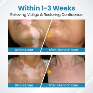 Vitiligo Therapy Device - Image 9