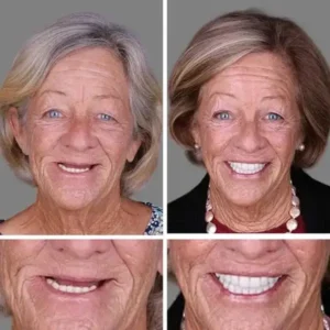 –Ends Today: 75% OFF! Full Denture with Strong Suctiond Custom-Fit Full Functional Dentures🦷 - Image 11