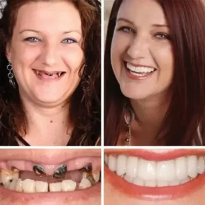 Ends Today: 75% OFF! Full Denture with Strong Suctiond CustomFit Full Functional Dentures🦷 - Image 10
